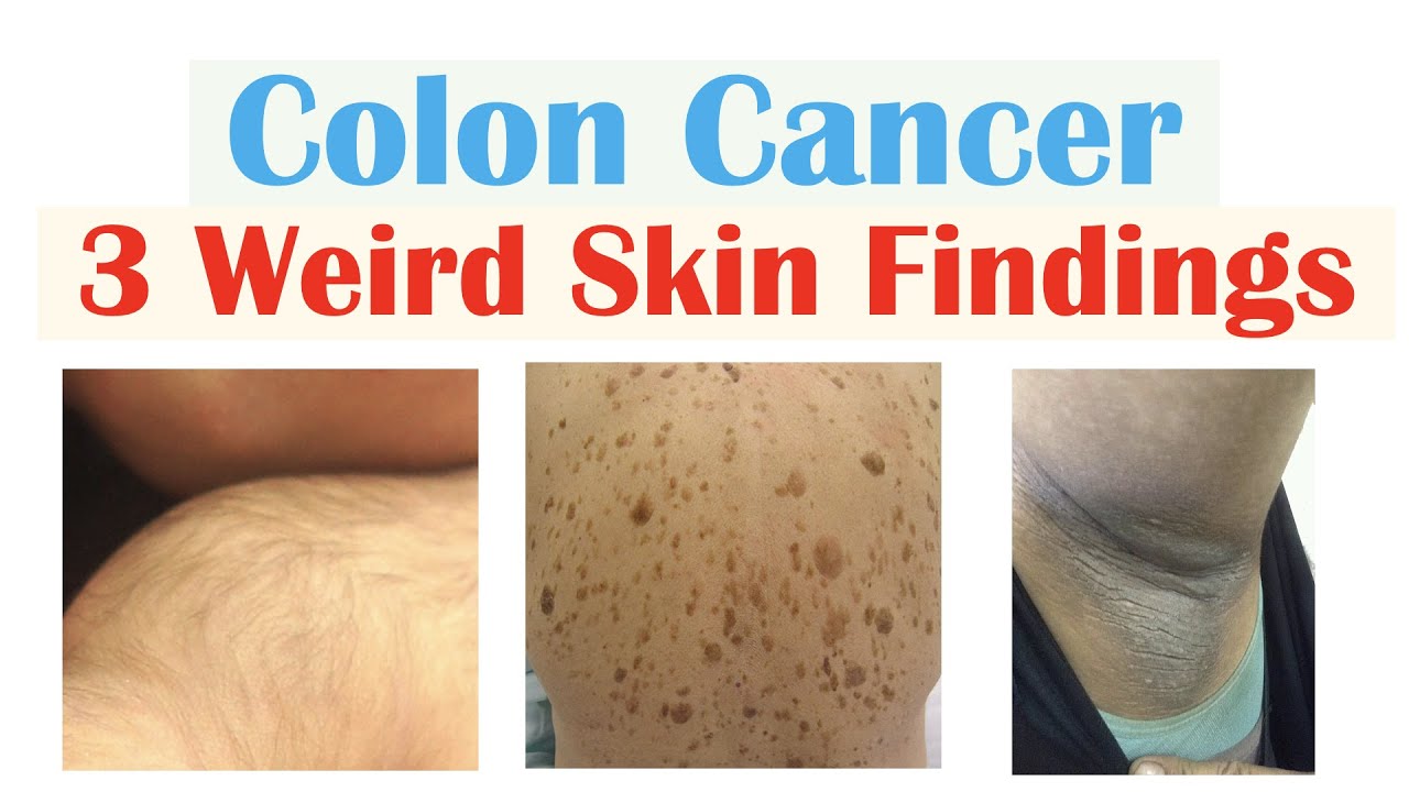 Weird Signs Of Colon Cancer Found On The Skin Youtube