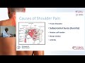 Shoulder pain common causes  treatment options with dr kashif ali