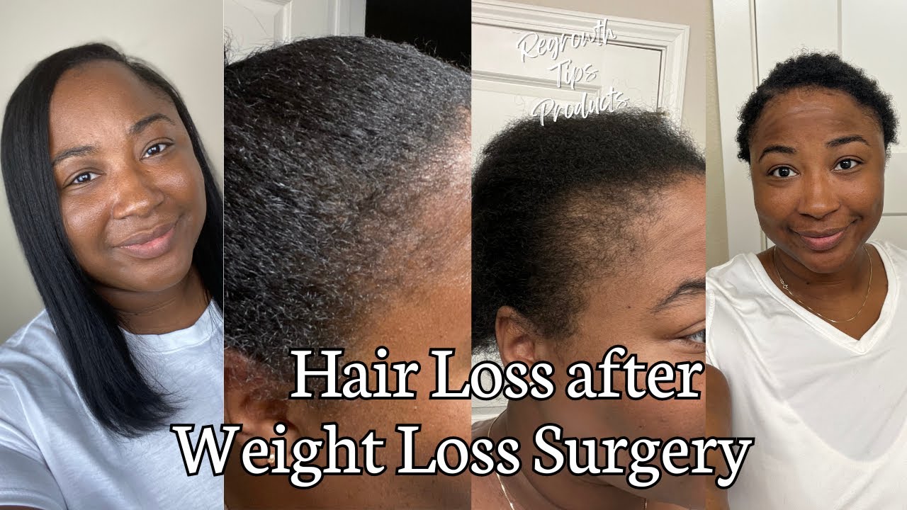 Hair Loss after Weight Loss Surgery Regrowth Tips, Products, & things