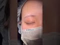 【二重整形】他院で手術を断られた?!#shorts