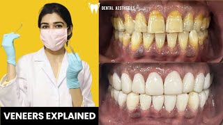 Don't Miss This Guide to Veneers: Cost, Types, and Procedure | Before And After
