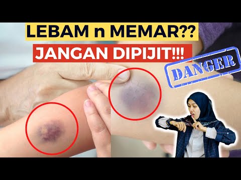 Video: Cara Merawat Lebam di Muka: 12 Langkah (dengan Gambar)