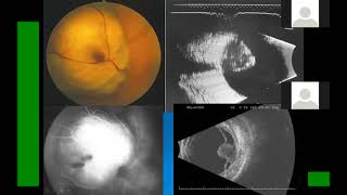 tumeurs de l'œil et ses annexes (ophtalmologie )