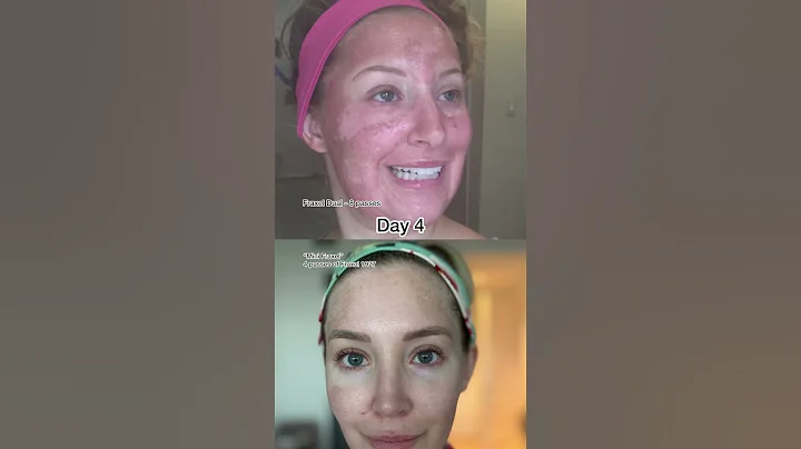 Fraxel Dual VS Mini Fraxel