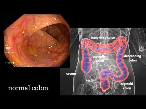 This video demonstrates an endoscopy procedure for a suspected bleeding ulcer.. 
