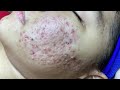 Blackheads, Acne Puberty P1 | Mụn Đầu Đen, Mụn Tuổi Dậy Thì P1 - SacDepSpa#280