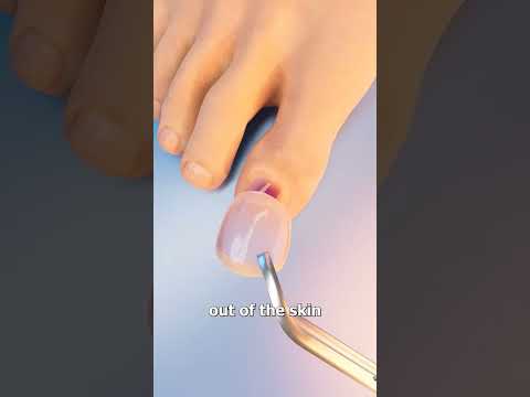How Toenail removal
