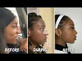 NOSE JOB UPDATE! ONE YEAR LATER! WAS IT WORTH IT? | 12 DAYS OF CHINEL-HO