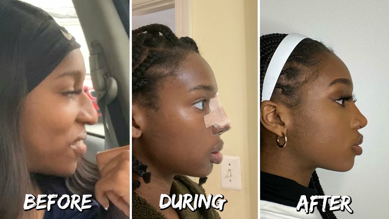 NOSE JOB UPDATE! ONE YEAR LATER! WAS IT WORTH IT? 12 DAYS OF CHINEL