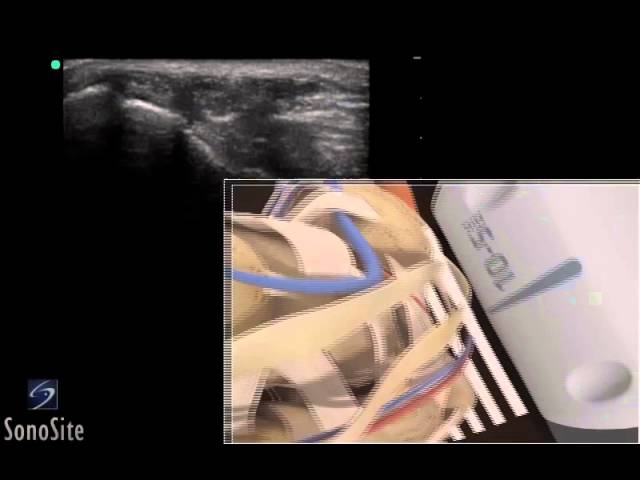 3D-пособие: ультразвуковое исследование сухожилия сгибателя голеностопного сустава — SonoSite