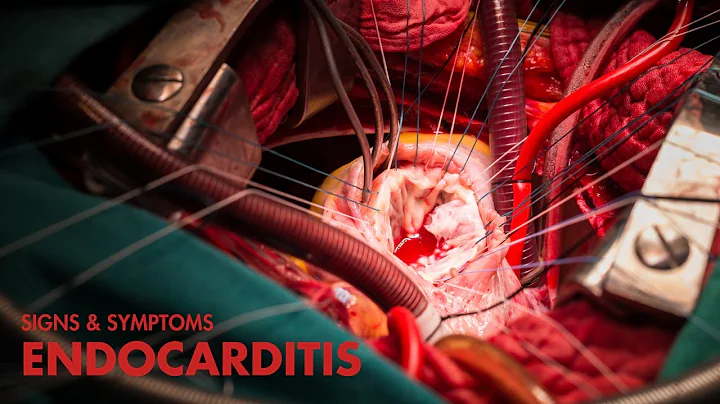 Signs and Symptoms of Endocarditis (Mnemonic)