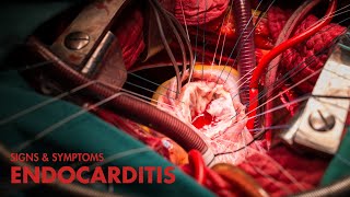 Signs and Symptoms of Endocarditis (Mnemonic)