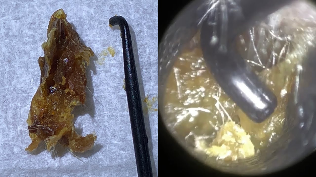 64 Dry Hardened Plug of Ear Wax & Dead Skin Extracted using St Bart’s