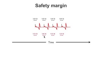 Pacemaker Issues Explained (Part 1): Understanding Failure to Capture