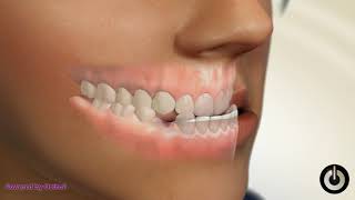 Lower 1st  Premolar Extraction | Dental Braces | Temecula Valley, CA