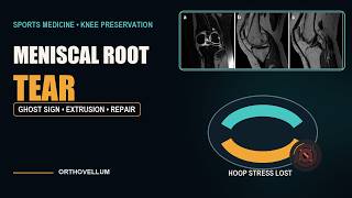 Meniscal Root Tears — The Hoop-Stress Failure