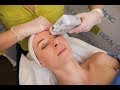 Hifu nonsurgical face lift with the doublo s