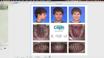 Quick Ceph Studio - Customize Gallery to adjust Maxilla and Mandible