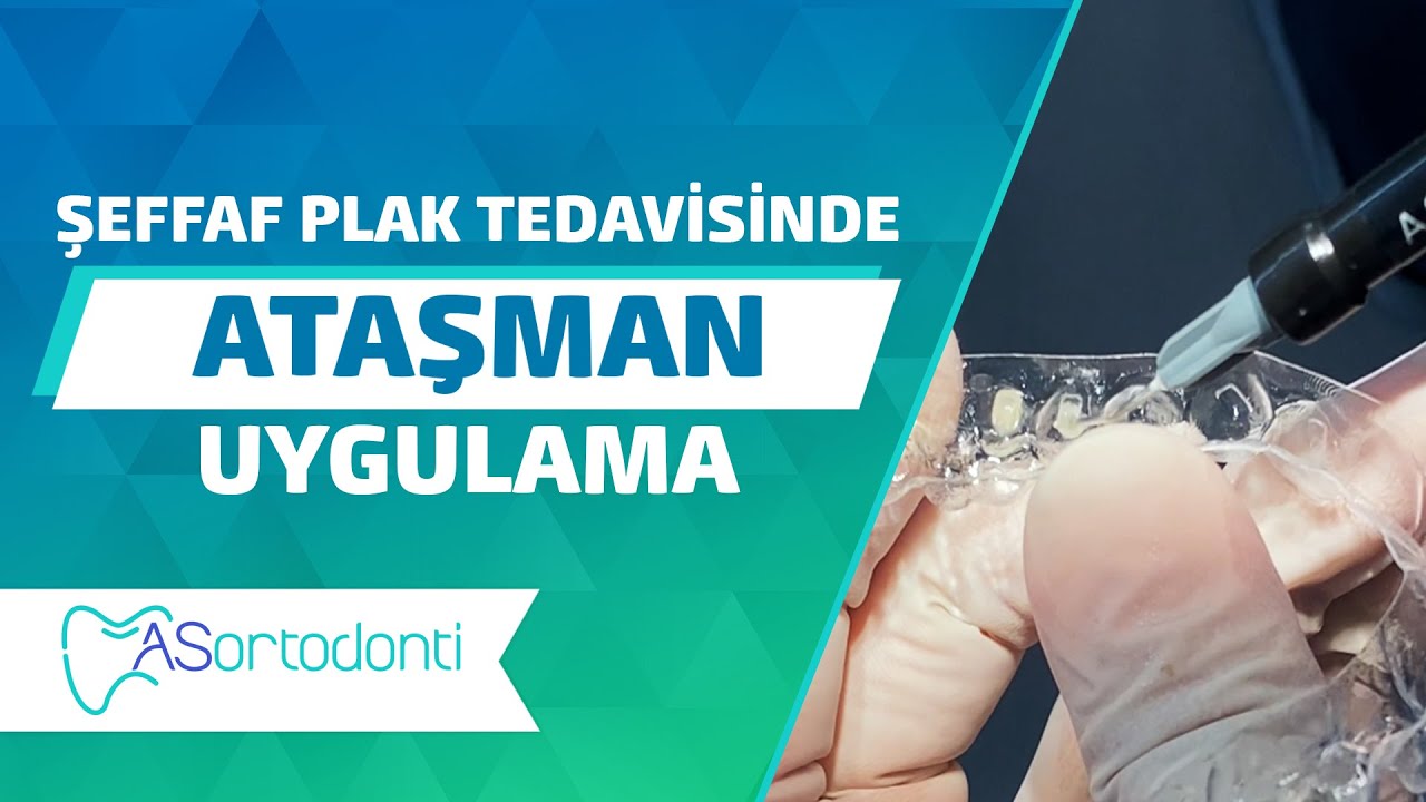 Şeffaf Plak Tedavisinde Ataşman Uygulama | AS Ortodonti