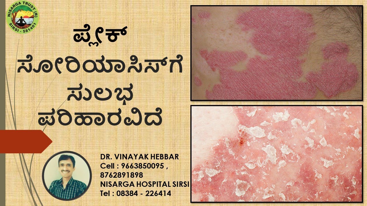 How To Cure Plaque Psoriasis Home Remedies for Plaque Psoriasis DR