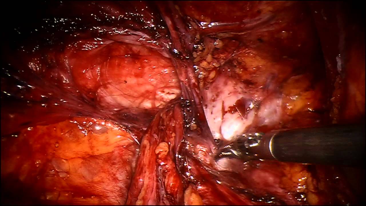 Robotic repair LIH recurrence after Kugel repair