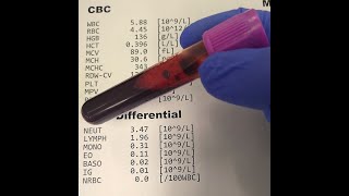 Physician explains how to read a complete blood count (CBC)