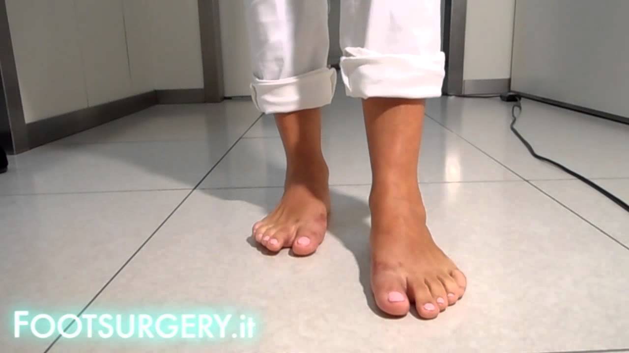 Hallux Valgus corrected with minimally invasive surgery of Dr. Andrea