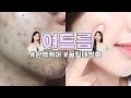 (안보면 후회) 여드름박사가 알려주는 여드름 없애는 방법 | 여드름 흉터 관리, 여드름피부 스킨케어, 관리방법까지! | 우리 WOORI