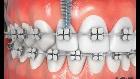 Interproximal Brush With Braces