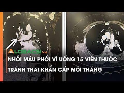 Video Nhồi máu phổi vì uống 15 viên thuốc tránh thai khẩn... - youtube