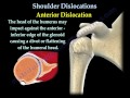 Shoulder Dislocations ,Everything You Need To Know - Dr. Nabil Ebraheim