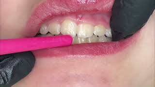 What are mamallons on teeth? by Hygiene Edge 2,892 views 4 months ago 56 seconds