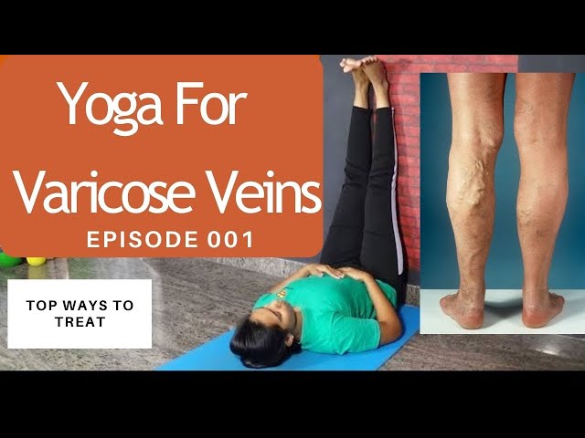 Best Exercises For Varicose Veins | Advanced Medical Group