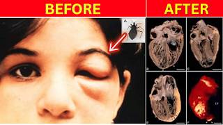 A Bug Bit Her Face In Mexico. 12 Years Later, Her Heart Stopped.