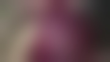 Anatomical segmentectomy S8 of hepatocellular carcinoma