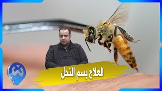 الابي ثيرابي.. تعرف على تقنية العلاج بسم النحل