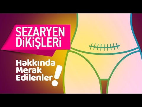 Sezaryen Dikişlerinde Ağrı ve Şişme Neden Olur? Sezeryan Dikişleri Nasıl Alınır?