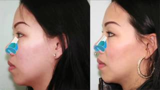 Asian Rhinoplasty Tip Projection Introduction & Explanation | Dr. Buonassisi, 8 West Clinic in BC