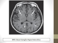 Prognostication after Cardiac Arrest