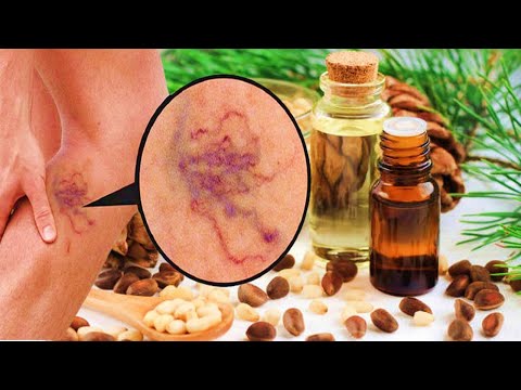 How to Get Rid of Varicose Veins In Your Legs With Essential Oils