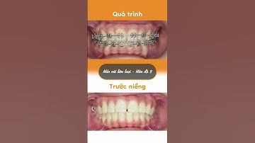 Hành trình LỘT XÁC nhờ niềng răng của Thúy An