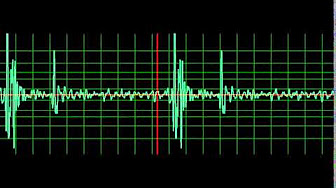 Heart Sounds - YouTube