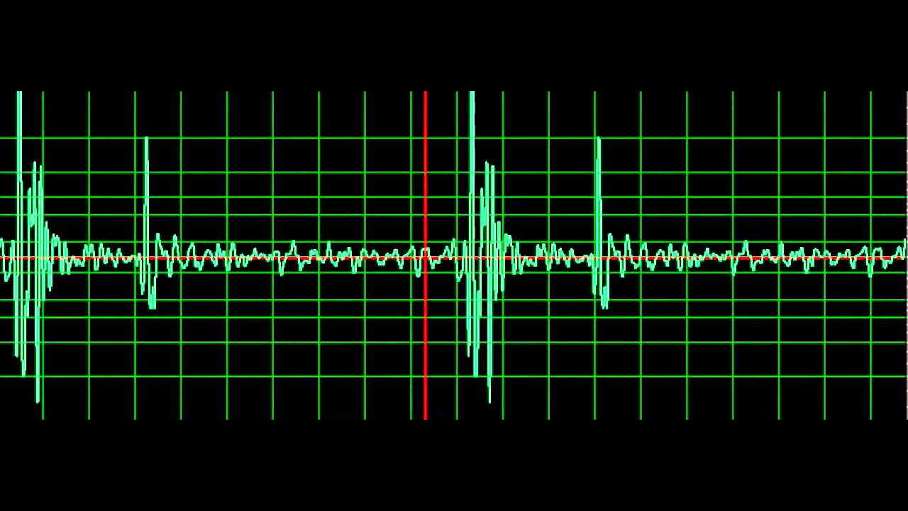 Heart Sounds
