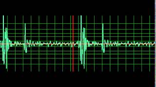 Normal Heart Sound- normal speed Resimi
