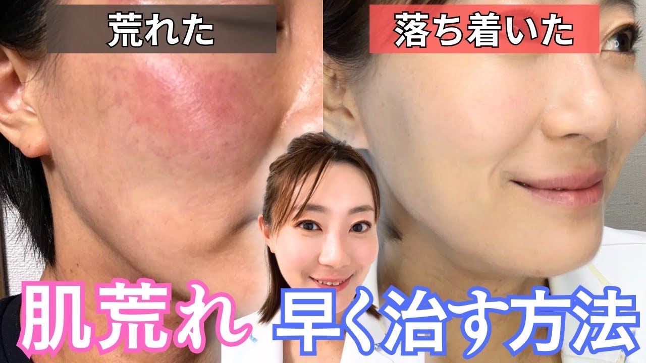 肌荒れしたら必ずやってほしい！治りを早める3つのこと