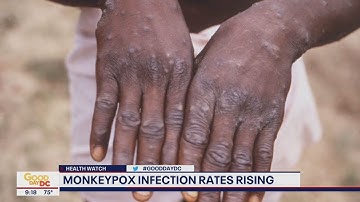 What rising monkeypox cases mean for DC, Maryland and Virginia | FOX 5 DC
