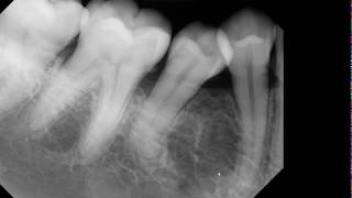 Is there a radiolucent lesion?
