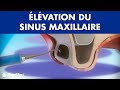 Sinus lift en franais 