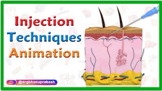 Injection Techniques Animation : Intradermal, Intramuscular, Subcutaneous and Z track screenshot 1