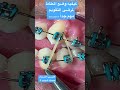 لمرضى التقويم كيف نضع المطاط بين الأسنان شاهد قبل الحذف 